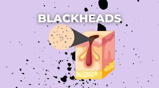 Blackheads: What They Are and The 4 Step Treatment Cure