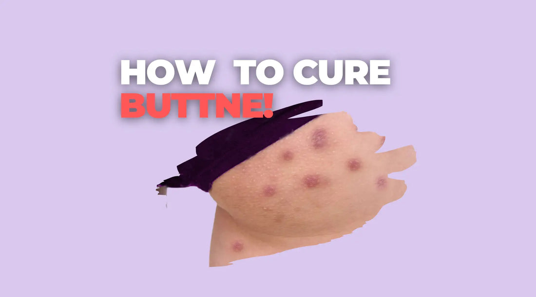 How To Treat Buttne