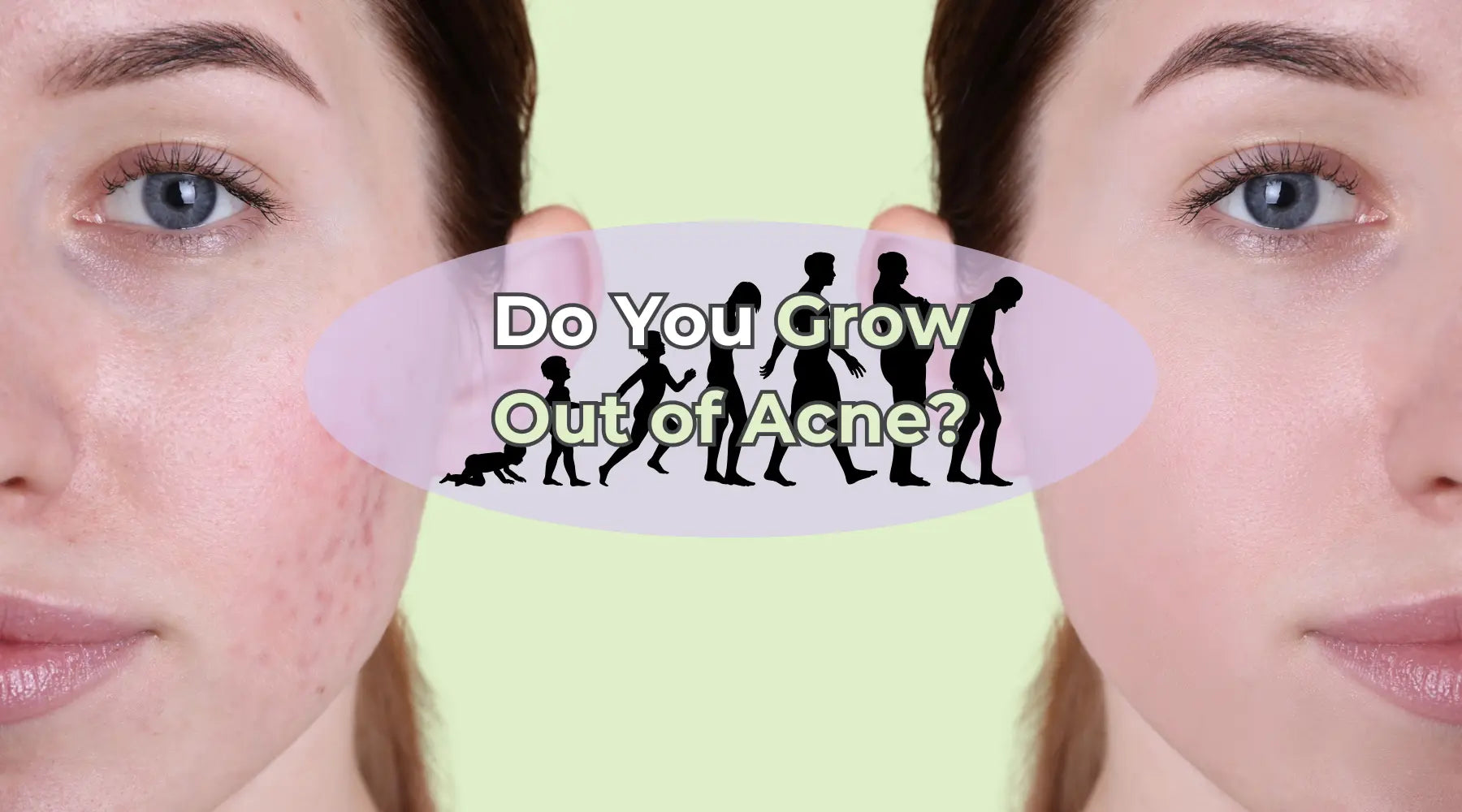 Is it Possible to Fully Outgrow Acne?