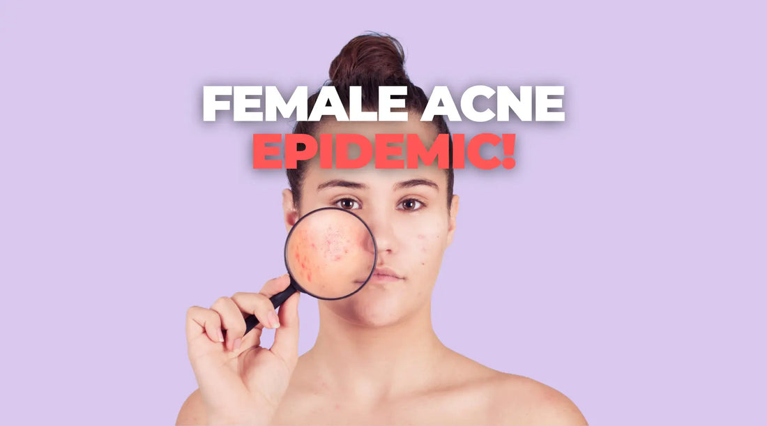 Why Women Are Getting More Acne Than Ever
