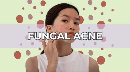 Understanding Fungal Acne: Causes, Symptoms, and Treatment