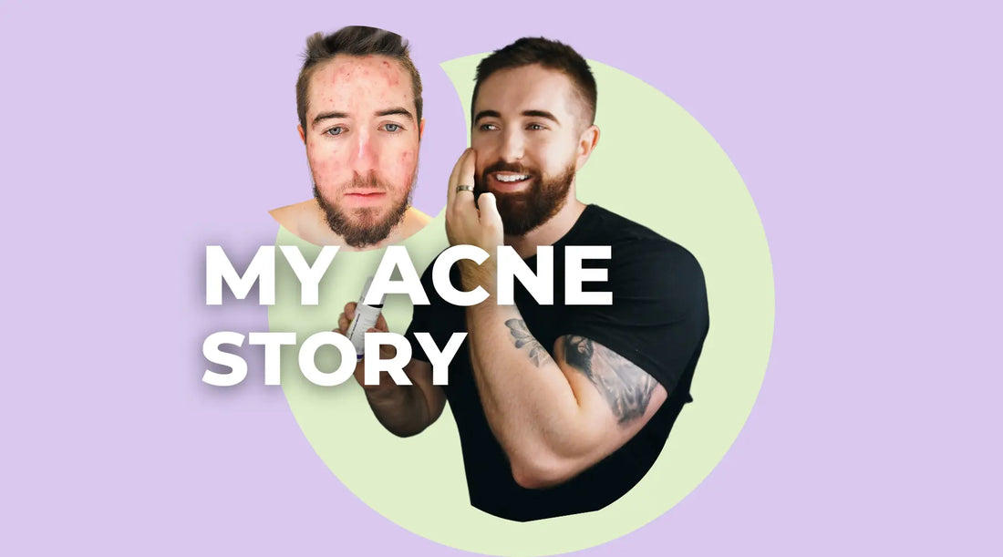 How I Cured My Acne Forever | My Acne Treatment Story