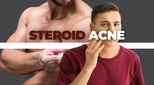 Steroid Acne | How It’s Caused? | How to Treat It?