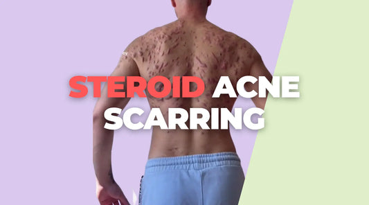 How To Prevent Acne Scarring From Anabolic Steroids