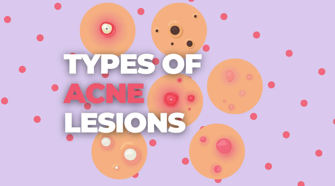 What Are The Different Types Of Lesions/Acne? | How Are Each Treated? | Whiteheads, Blackheads, Papules, Pustules. Nodules and Cysts