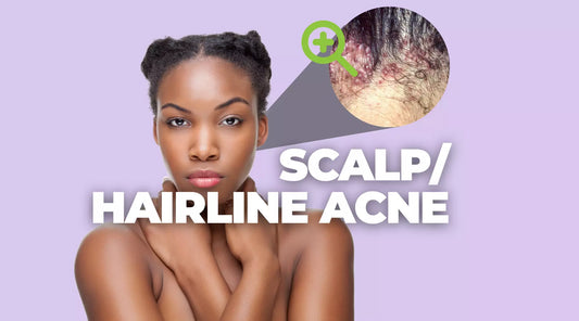 Top 5 Tips to Treat Scalp/Hairline Acne